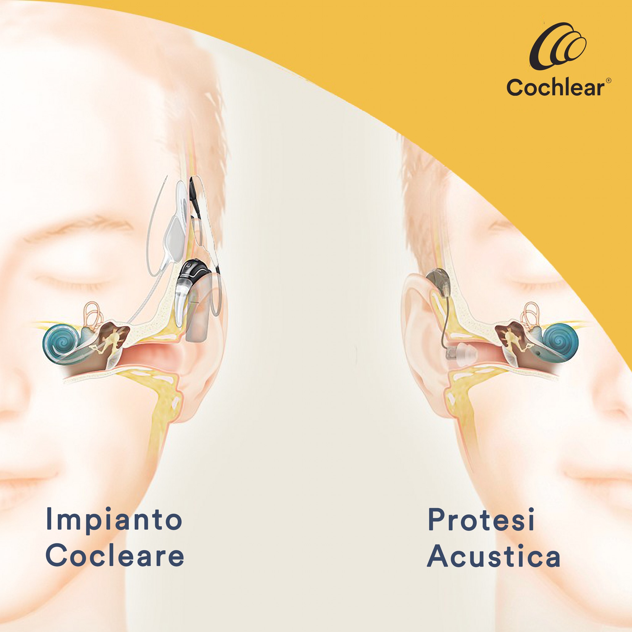 Impianti cocleari e Baha